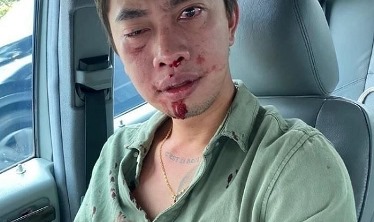 Muka Anak Anggota DPR Berdarah, Akibat Disundul Ketua Pemuda Bravo 5